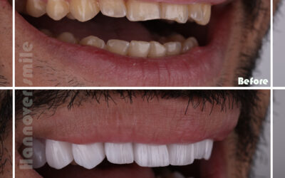 Dental stains are of two different types: internal stains and external stains