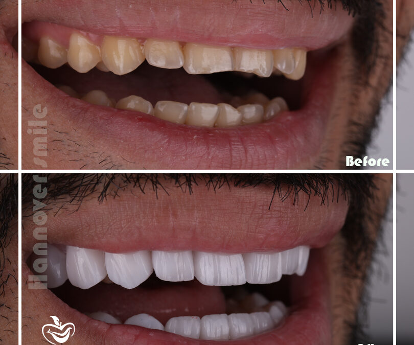 Dental stains are of two different types: internal stains and external stains