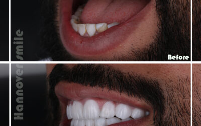 How much are dental implants?