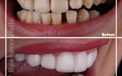 How do I get a perfect white smile?