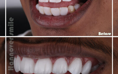 Surgical – Painless Teeth removal – Non-Surgical