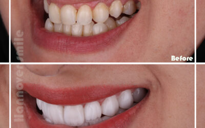 Is root canal painful?