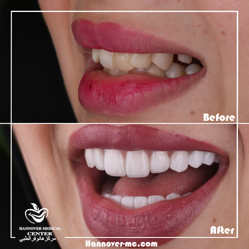 What age is best for braces? Hannover Medical Center Sharjah