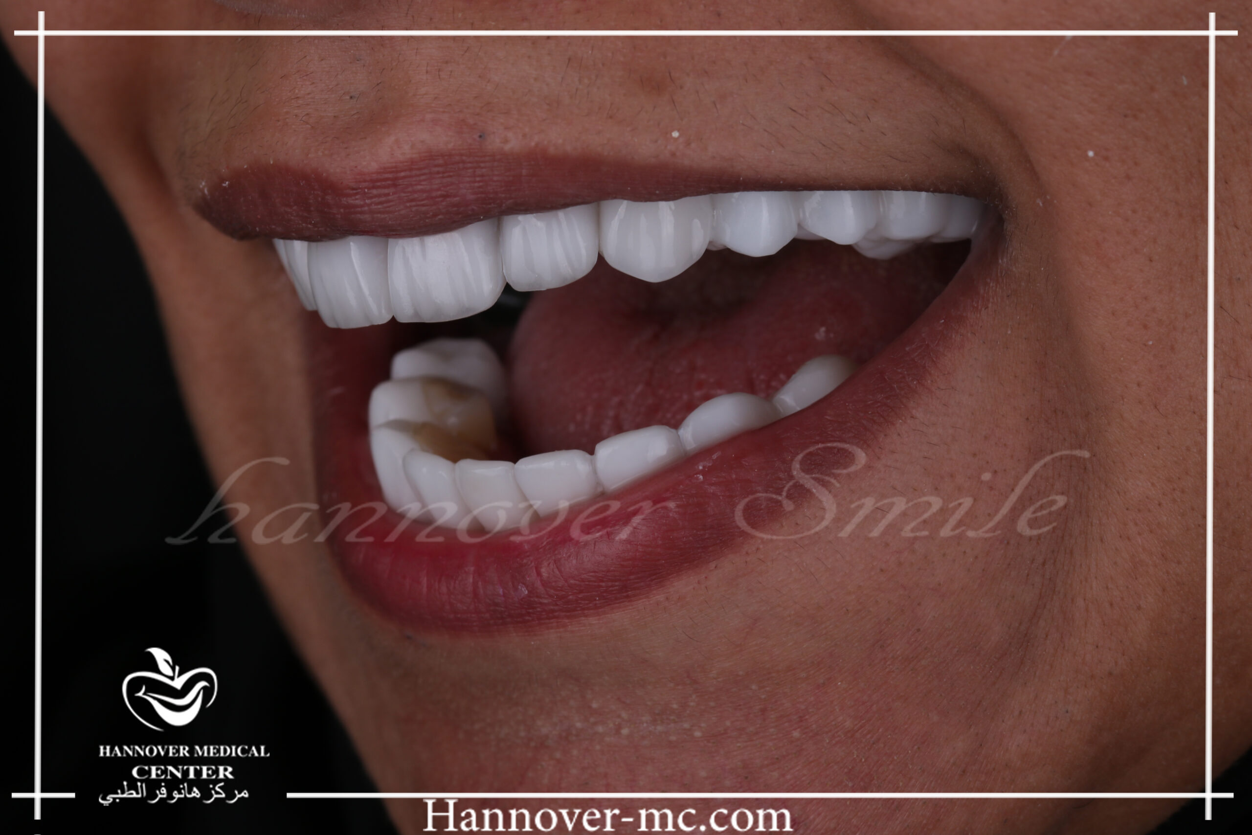 Are braces worth it? Hannover Medical Center Sharjah