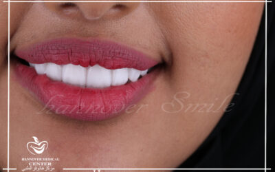 Caring for Porcelain Veneers