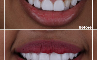 Instant Orthodontics