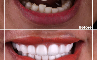 What are disadvantages of veneers?