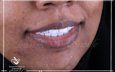 Do you have to brush veneers?