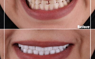 What’s the difference between veneers and lumineers?