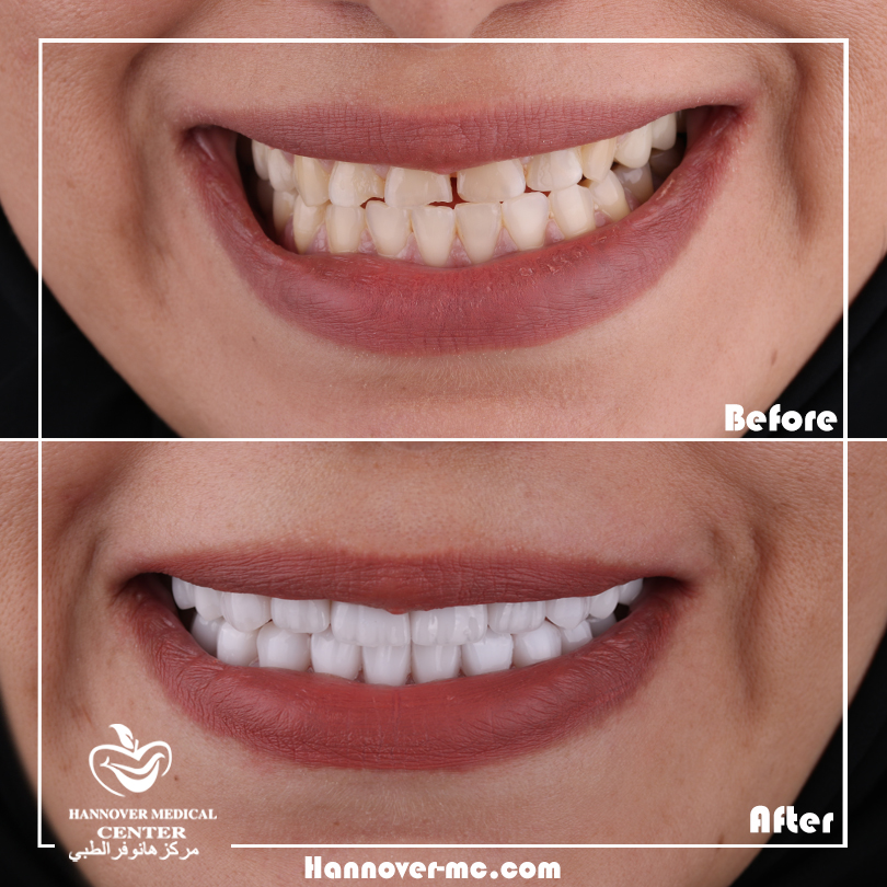 What's the difference between veneers and lumineers? Hannover Medical