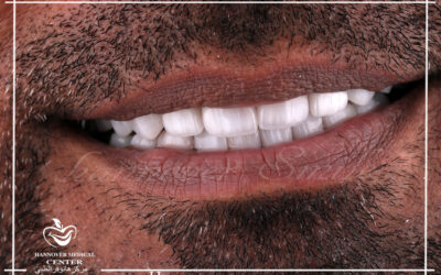 Do veneers ever look natural?