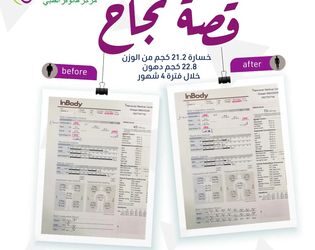 عملية نحت الجسم: التجارب, الأسعار, الأطباء, الصور واكثر