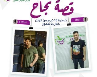 القضاء على التجاعيد الرقيقة في الجلد