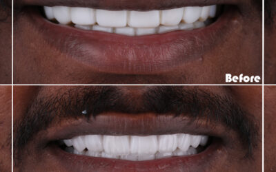 Do braces change your face shape?