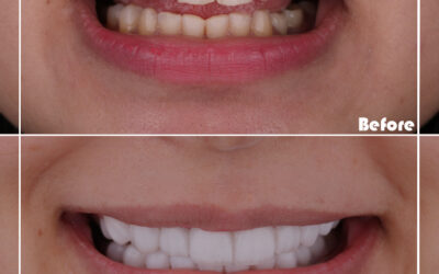 How long do adults wear braces?