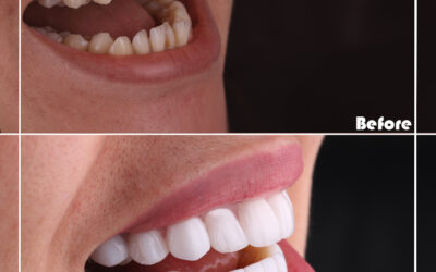 What Happens if a Veneer Falls Off or Breaks?