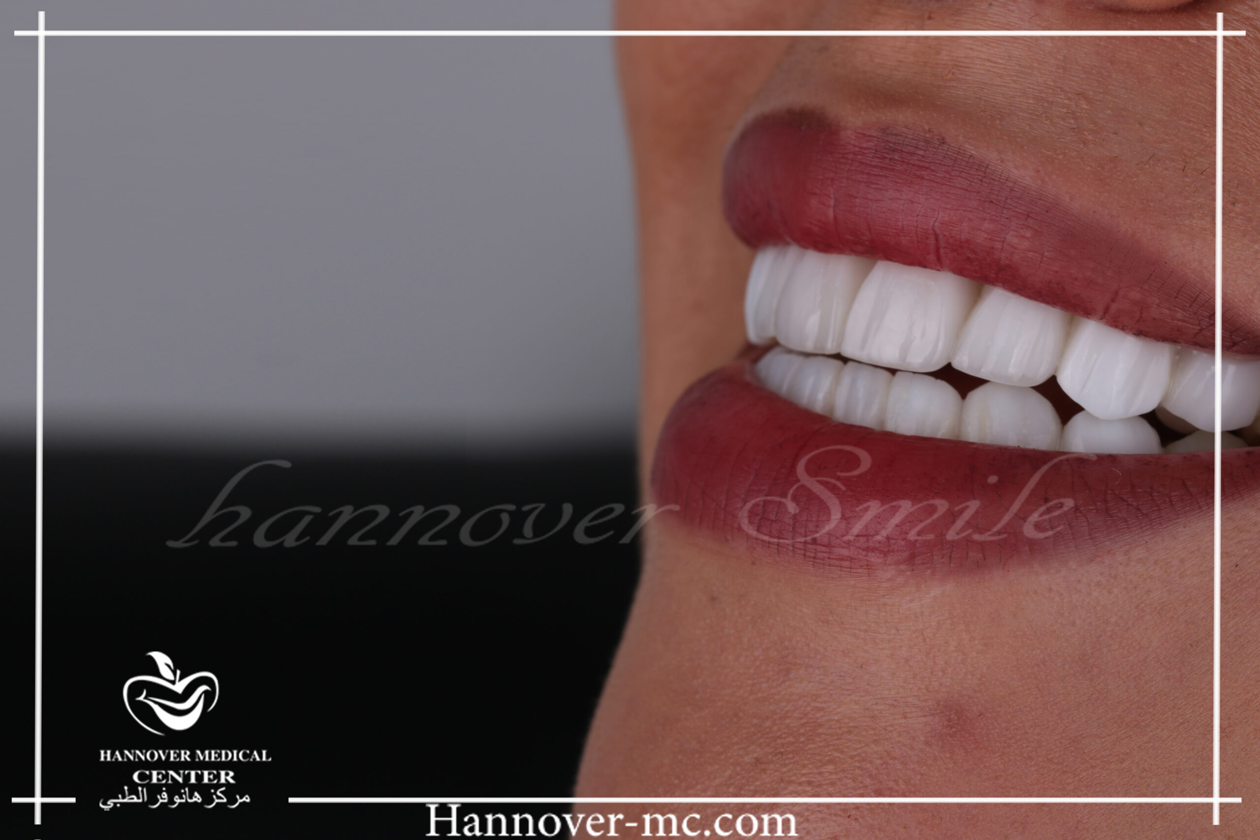 Do we need to remove teeth for braces? Hannover Medical Center Sharjah