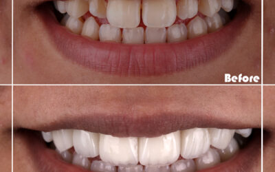 Do You Need a Sinus Lift Before Getting Dental Implants?