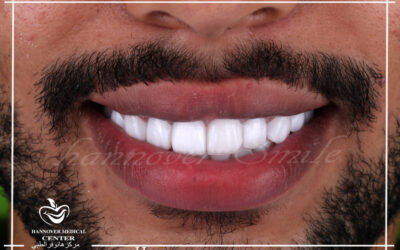 Do we need to remove teeth for braces?