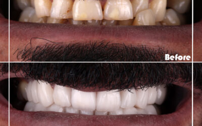 Common Appearance Problems Veneers can Treat