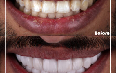 7 Benefits of Getting Invisalign Treatment