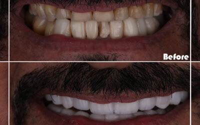 Why do veneers look so big?