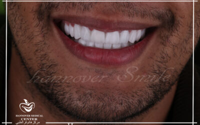 How much does it cost to replace a full set of teeth?