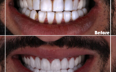 Teeth Whitening: The Benefits of This Cosmetic Dental Procedure