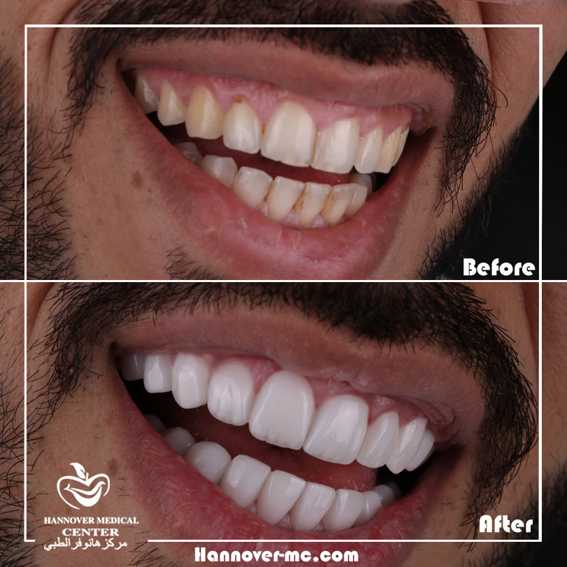 Are veneers cheaper than implants? Hannover Medical Center Sharjah