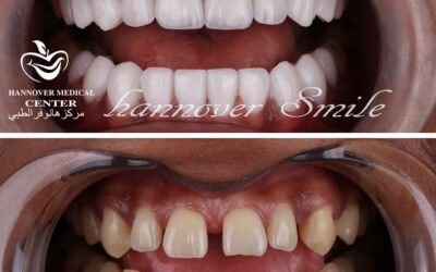 Youthful veneers