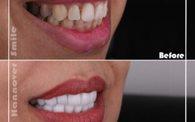 Dental Offers –  Zoom Whitening + Scaling