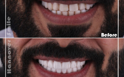 Veneers Dental implants