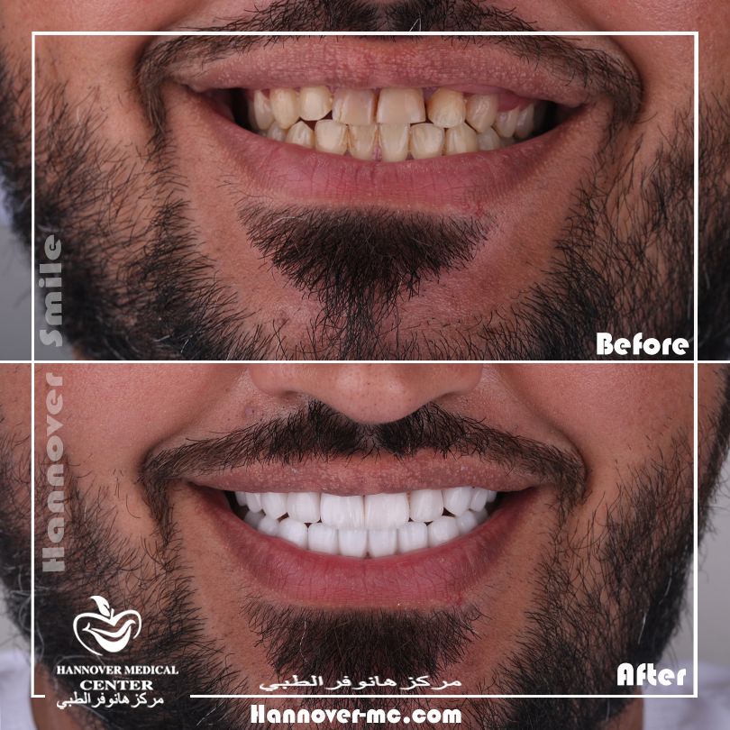 HOW COSMETIC DENTISTRY CAN BE VALUABLE TO YOUR SMILE Hannover Medical